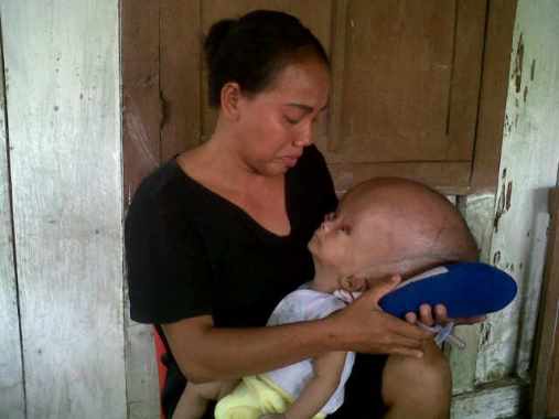 Alviano Luntungan, bayi penderita penyakit hydrosepalus. (foto: finda/BMC)