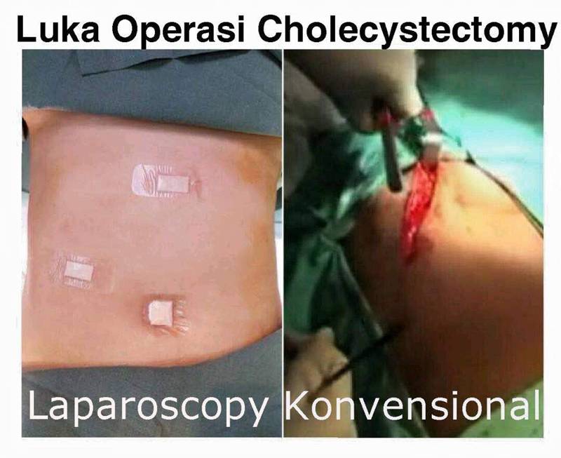 Operasi Laparoscopy