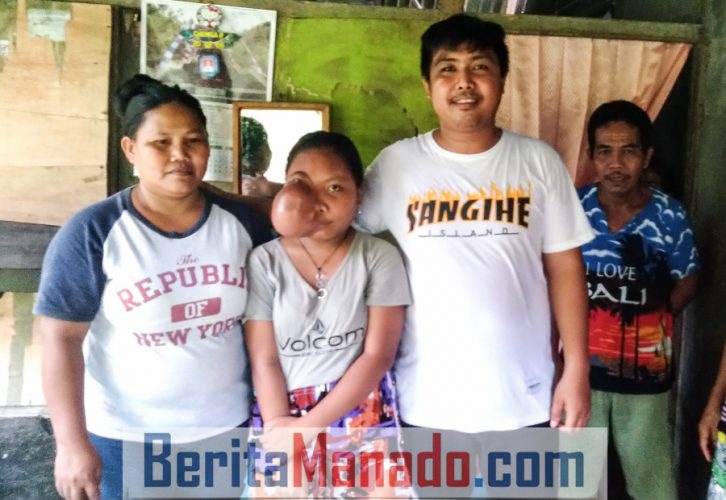 Chrismelia Ratundulage, Anak dengan Tumor di Wajah Jalani Pengobatan di RSUP Kandou Manado