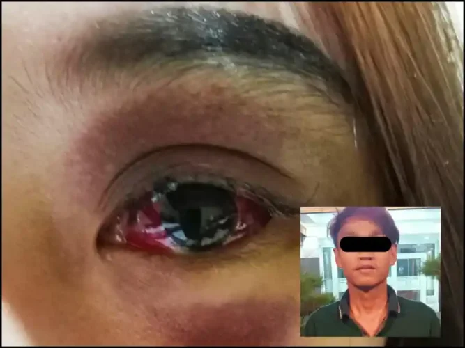 Dengan Mata Lebam Gadis Manado ini Melapor Telah Dianiaya Lelaki Pengangguran