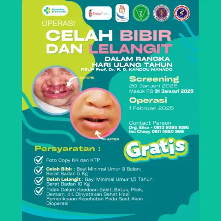 Syukur HUT ke-30, RSUP Kandou Manado Gelar Operasi Gratis Celah Bibir dan Lelangit